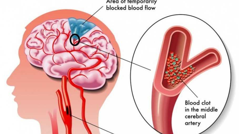 Cegah Stroke Lewat Pola Makan dan Olahraga Teratur – PAFI Kab. Kampar